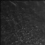 Pancreatic Cancer and the Whipple Procedure