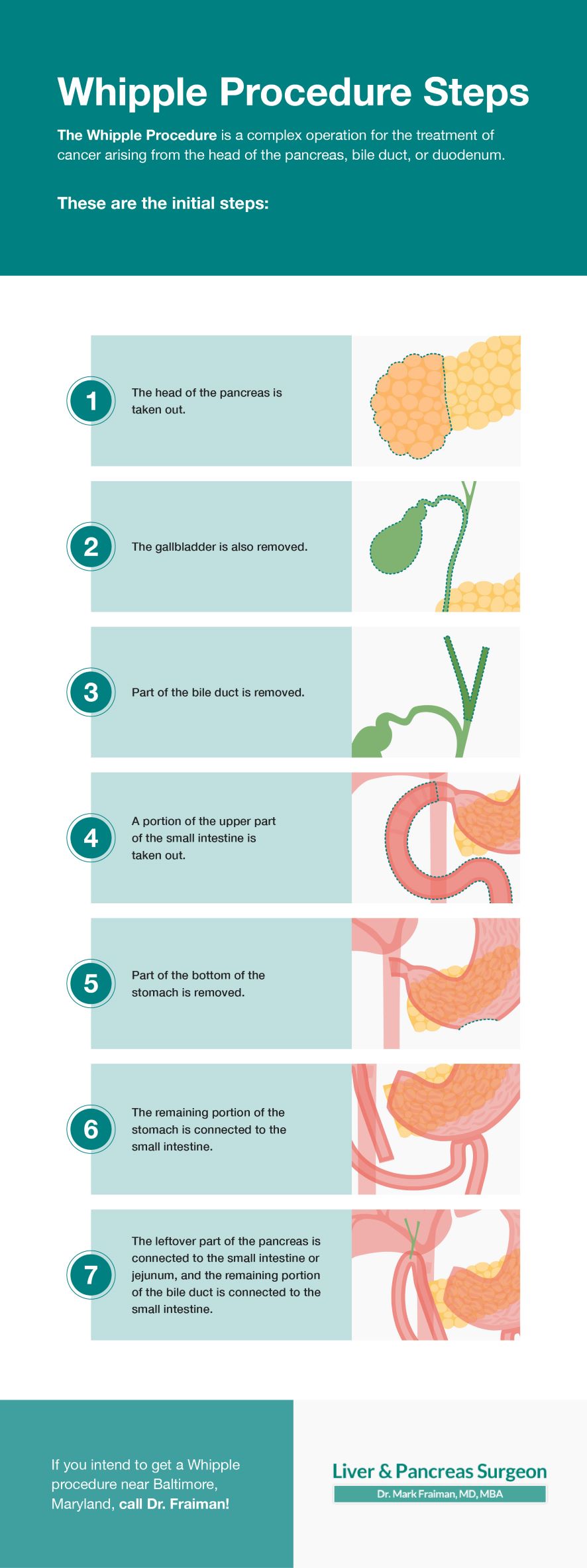 whipple procedure for pancreatitis